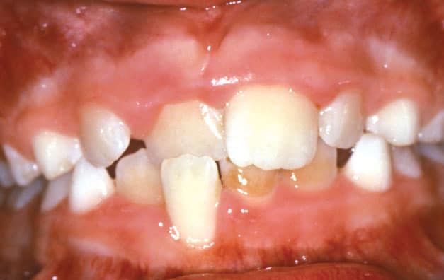 Crossbite Worthington Orthodontics in Paoli, PA