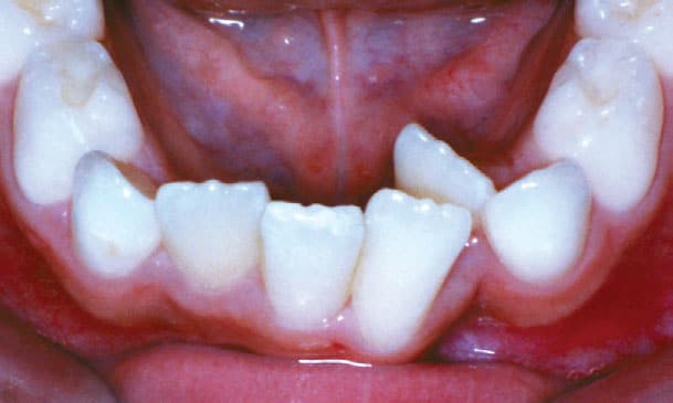 Crowding Worthington Orthodontics in Paoli, PA