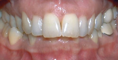 Overbite Worthington Orthodontics in Paoli, PA