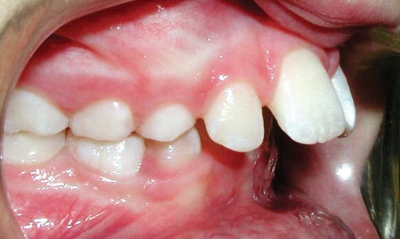 Protrusion Worthington Orthodontics in Paoli, PA