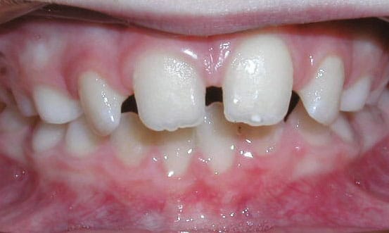 Spacing Worthington Orthodontics in Paoli, PA