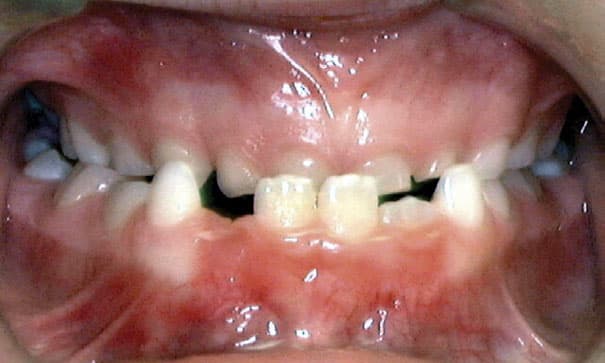 Underbite Worthington Orthodontics in Paoli, PA