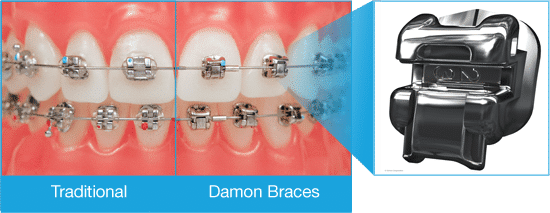 Damon Braces Worthington Orthodontics in Paoli, PA