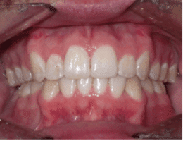 After Orthodontic Treatment Worthington Orthodontics in Paoli, PA