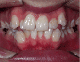 Before Orthodontic Treatment Worthington Orthodontics in Paoli, PA