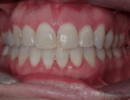 After Orthodontic Treatment Worthington Orthodontics in Paoli, PA