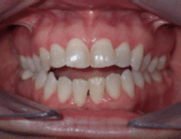 Before Orthodontic Treatment Worthington Orthodontics in Paoli, PA