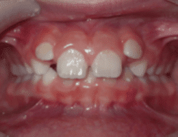 Before Orthodontic Treatment Worthington Orthodontics in Paoli, PA