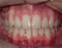 After Orthodontic Treatment Worthington Orthodontics in Paoli, PA