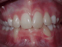 Before Orthodontic Treatment Worthington Orthodontics in Paoli, PA